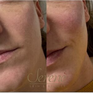 Cheek Filler